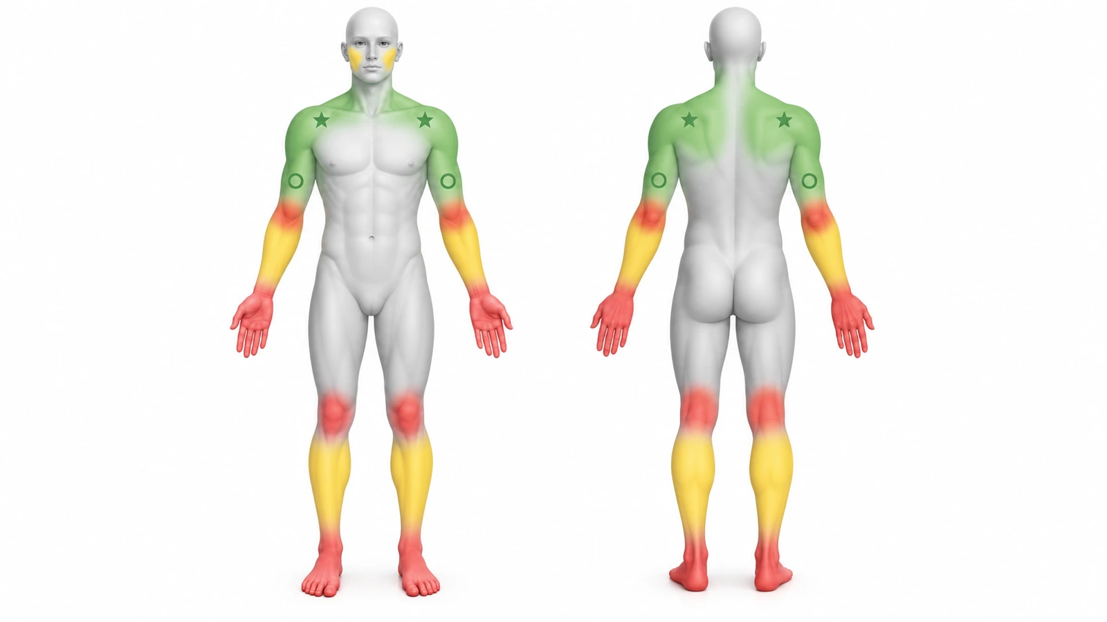 Silhuetas do corpo, frente e costas, com código de cores: verde nos ombros, parte superior das costas e antebraços internos; amarelo nos antebraços externos e panturrilhas; e vermelho nas mãos, dedos, pulsos, cotovelos, joelhos e pés